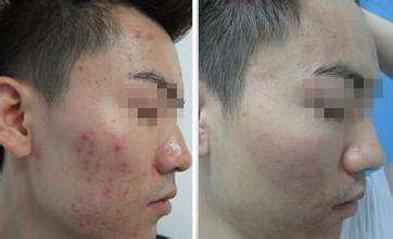 anti-inflammatory effect of phloretin
